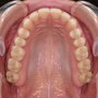 Upper dental arch